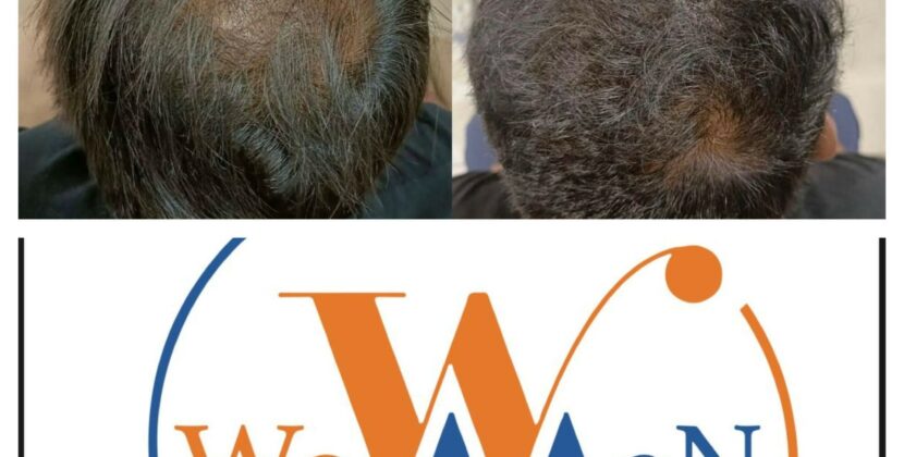 “WowMen Clinic: 10+ Years & 4500+ Satisfied Clients, A Leader in Sustainable Cosmetic Treatments!”