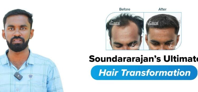 REVERSING BALDNESS WITH VCARE 