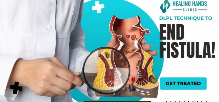 How to Cure Fistula Permanently?- DLPL Fistula Treatment 