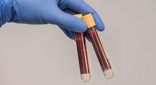 How Routine Blood Tests Can Help You Stay Ahead of Health Issues?