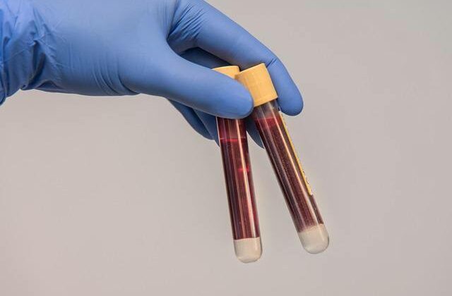 How Routine Blood Tests Can Help You Stay Ahead of Health Issues?