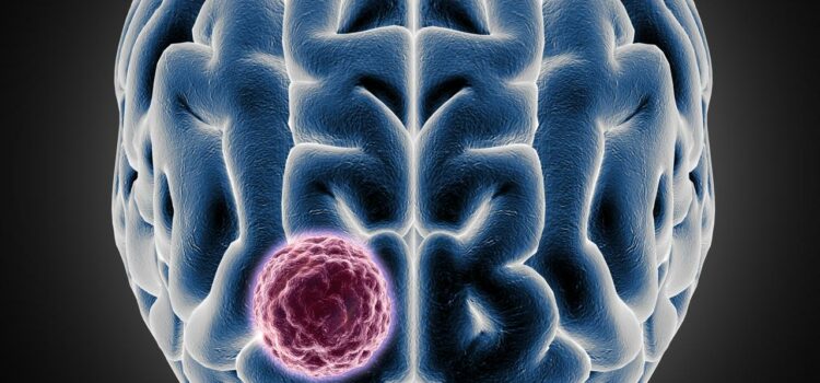 Sakra successfully conducts a landmark surgery for 10*9 cm giant meningiomaon a 34-year-old  international patient from Ghana