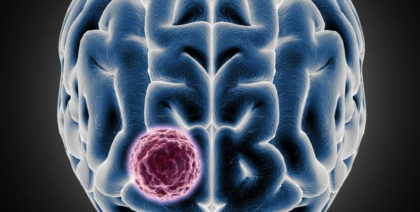Sakra successfully conducts a landmark surgery for 10*9 cm giant meningiomaon a 34-year-old  international patient from Ghana