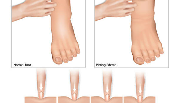 What is the most common cause of fluid retention and how it affects your blood pressure?