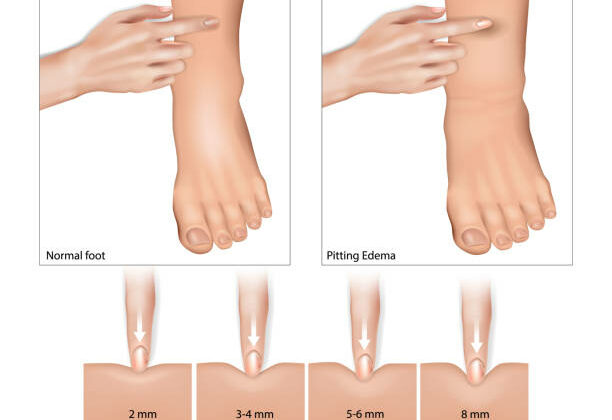 What is the most common cause of fluid retention and how it affects your blood pressure?